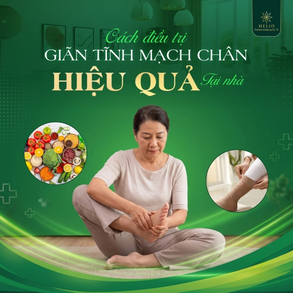 CÁCH ĐIỀU TRỊ GIÃN TĨNH MẠCH CHÂN HIỆU QUẢ TẠI NHÀ
