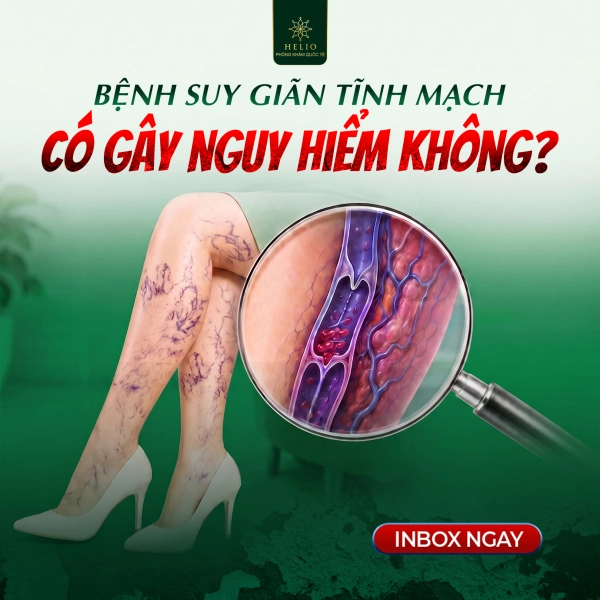 BỆNH SUY GIÃN TĨNH MẠCH CÓ GÂY NGUY HIỂM KHÔNG?