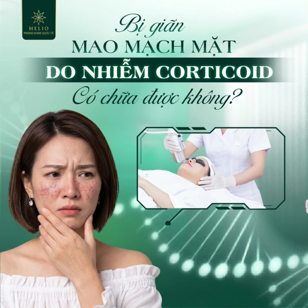 BỊ GIÃN MAO MẠCH MẶT DO NHIỄM CORTICOID CÓ CHỮA ĐƯỢC KHÔNG?