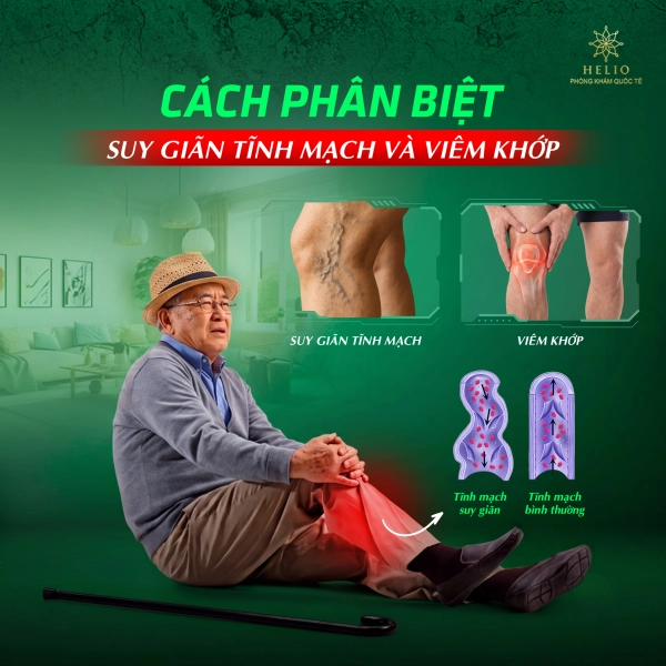 CÁCH PHÂN BIỆT SUY GIÃN TĨNH MẠCH VÀ VIÊM KHỚP