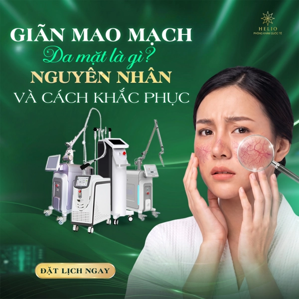 Giãn mao mạch da mặt là gì? Nguyên nhân và cách khắc phục