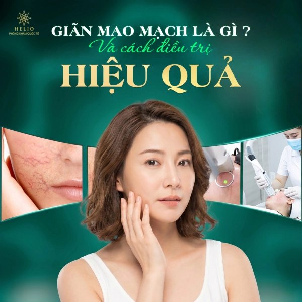 GIÃN MAO MẠCH LÀ GÌ? VÀ CÁCH ĐIỀU TRỊ HIỆU QUẢ