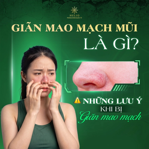 GIÃN MAO MẠCH MŨI LÀ GÌ? NHỮNG LƯU Ý KHI BỊ GIÃN MAO MẠCH