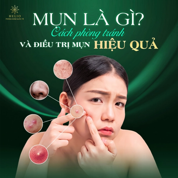 MỤN LÀ GÌ? CÁCH PHÒNG TRÁNH VÀ ĐIỀU TRỊ MỤN HIỆU QUẢ