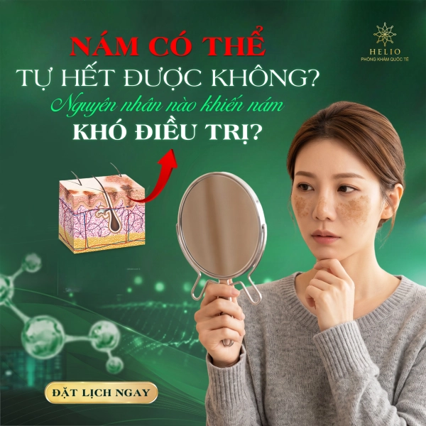 NÁM CÓ THỂ TỰ HẾT ĐƯỢC KHÔNG? NGUYÊN NHÂN NÀO KHIẾN NÁM KHÓ ĐIỀU TRỊ?