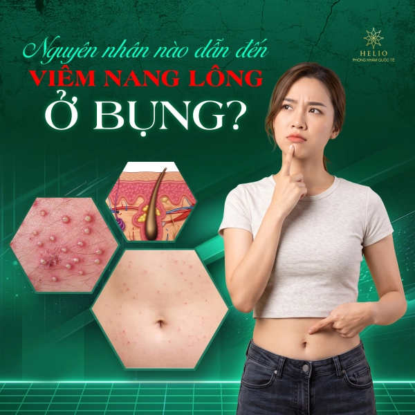 NGUYÊN NHÂN NÀO DẪN ĐẾN VIÊM NANG LÔNG Ở BỤNG?