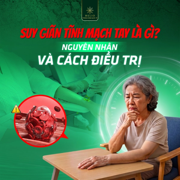 SUY GIÃN TĨNH MẠCH TAY LÀ GÌ? NGUYÊN NHÂN VÀ CÁCH ĐIỀU TRỊ