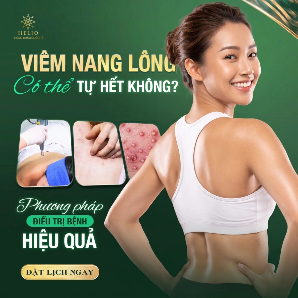 VIÊM NANG LÔNG CÓ THỂ TỰ HẾT KHÔNG? PHƯƠNG PHÁP ĐIỀU TRỊ BỆNH HIỆU QUẢ