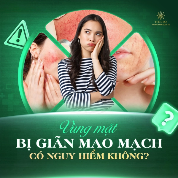 VÙNG MẶT BỊ GIÃN MAO MẠCH CÓ NGUY HIỂM KHÔNG?